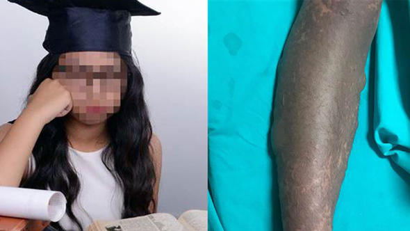 Antalya'da Psikiyatristin Verdiği İlaçları Kullanan Lise Öğrencisi Kız, Şimdi Yaşam Savaşı Veriyor!