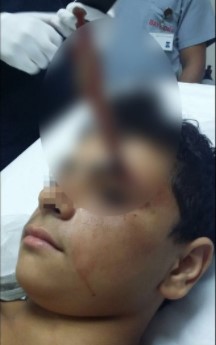 Mersin’de Dehşet! 15 Yaşındaki Suriyeli Çocuğun Kafasına Ekmek Bıçağı Sapladılar