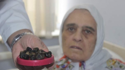 Denizli’de Yaşlı Kadının Safra Kesesinden Öyle Taşlar Çıktı Ki Doktorlar Bile Şaşkına Döndü